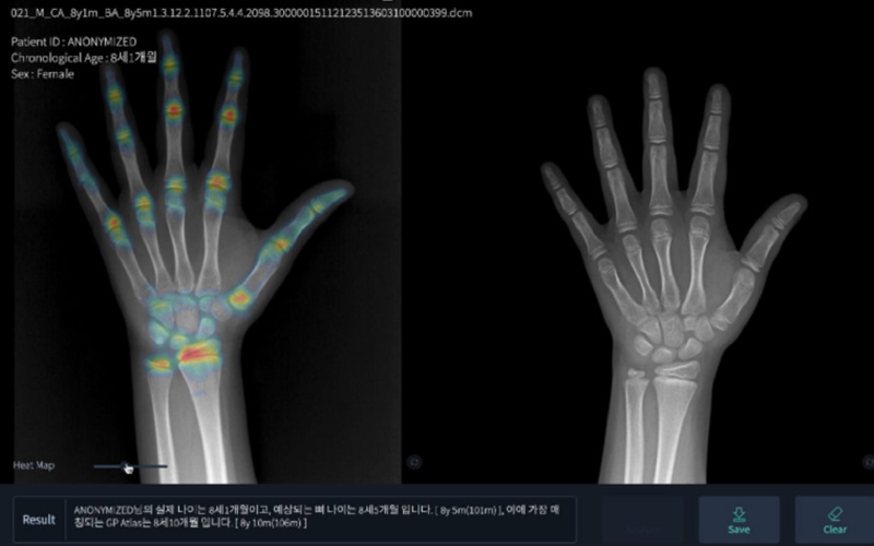 인공지능 기반 성장판 검사